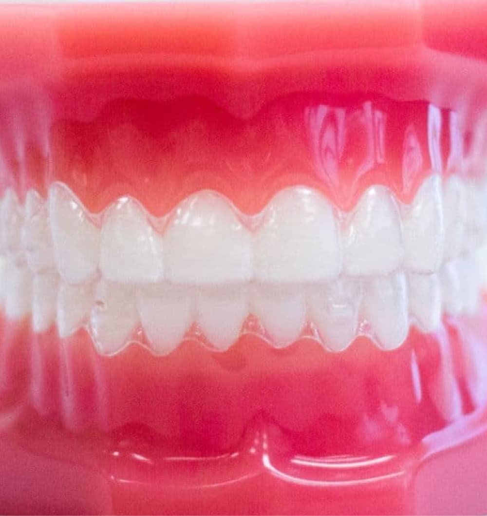 clear aligners on plastic model
