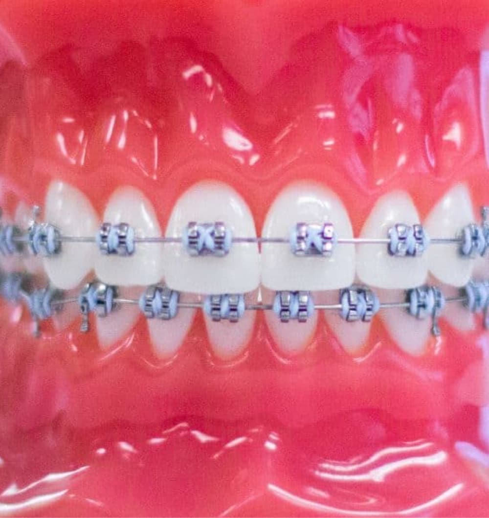 metal braces on plastic model