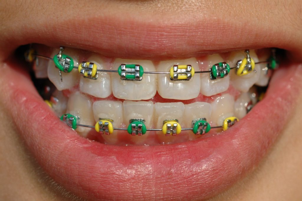 What is Included in Orthodontic Treatment?