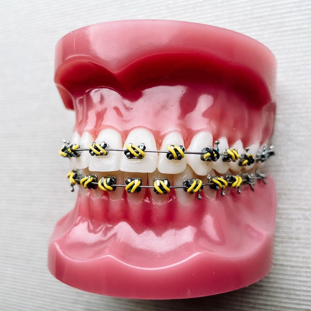 4 Reasons Traditional Braces Are a Better Choice Than Aligners